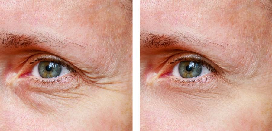 Фото морщин у глаз до и после процедуры